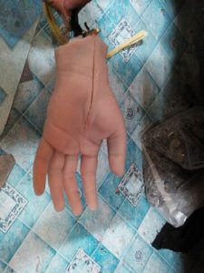 Tangan Palsu Tepat Pergelangan